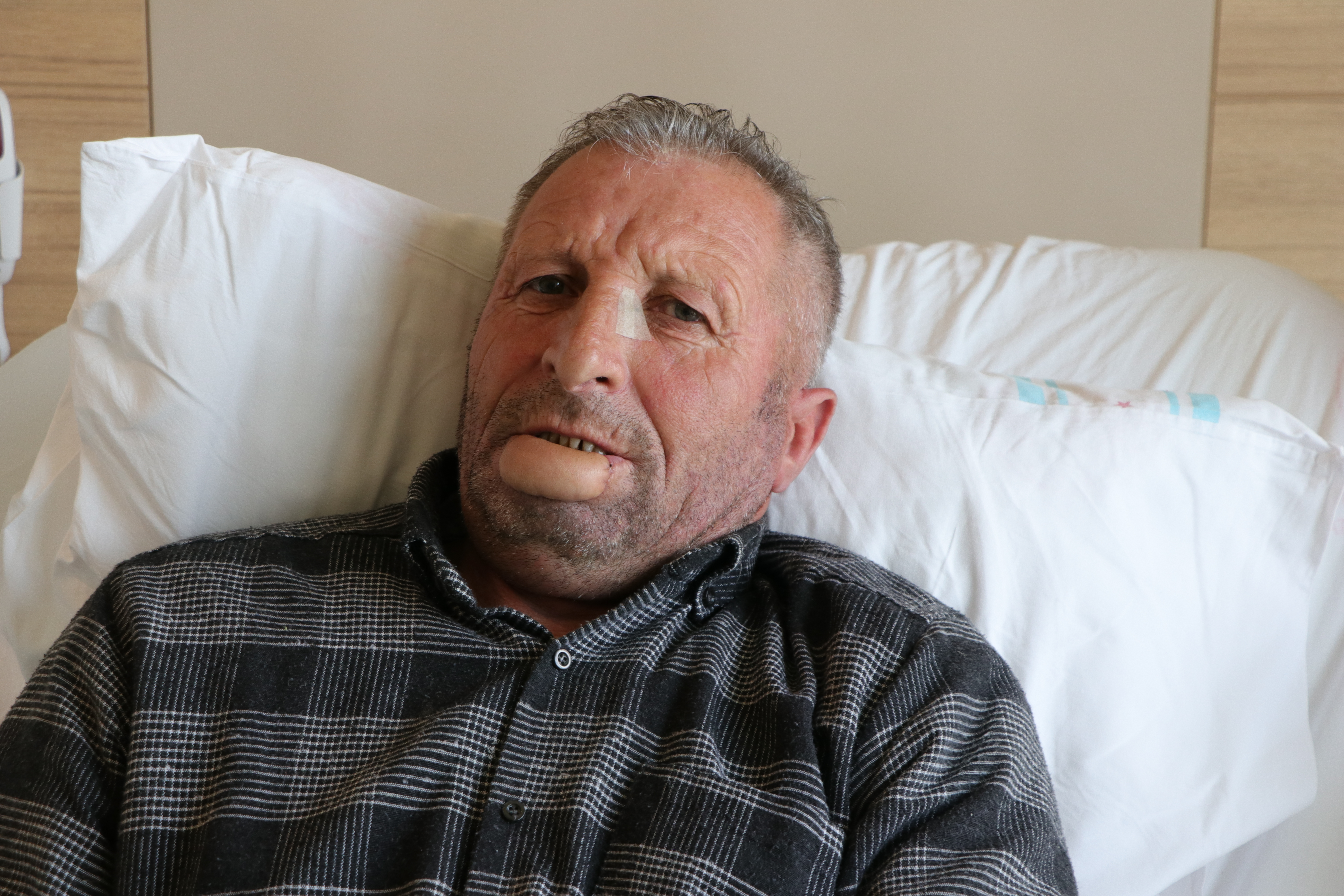 Kol derisinden yapılan dudakla sağlığına kavuştu