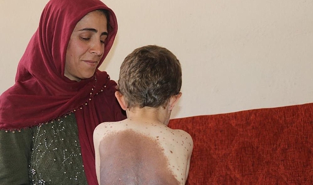 Küçük Samet vücudunu saran dev benlerin tedavi edilmesini istiyor