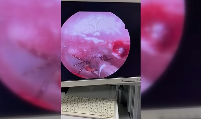 Kulak ağrısıyla hastaneye gitti, kulağından kene çıktı