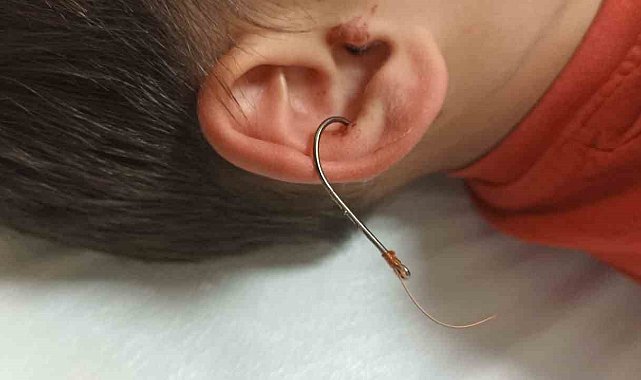 Oltayla oynarken kulağına olta kancası saplandı