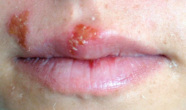 Uçuk deyip geçmeyin