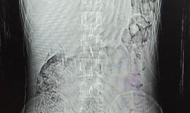 Midesinden 78 kapsül uyuşturucu çıktı