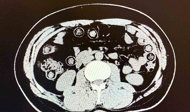 Muş'ta midelerinden 928 gram uyuşturucu çıkan 2 İranlı tutuklandı