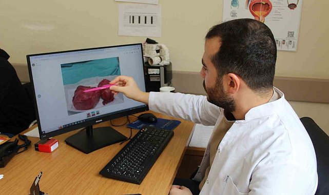 300 gramlık prostat dokusu başarıyla çıkarıldı