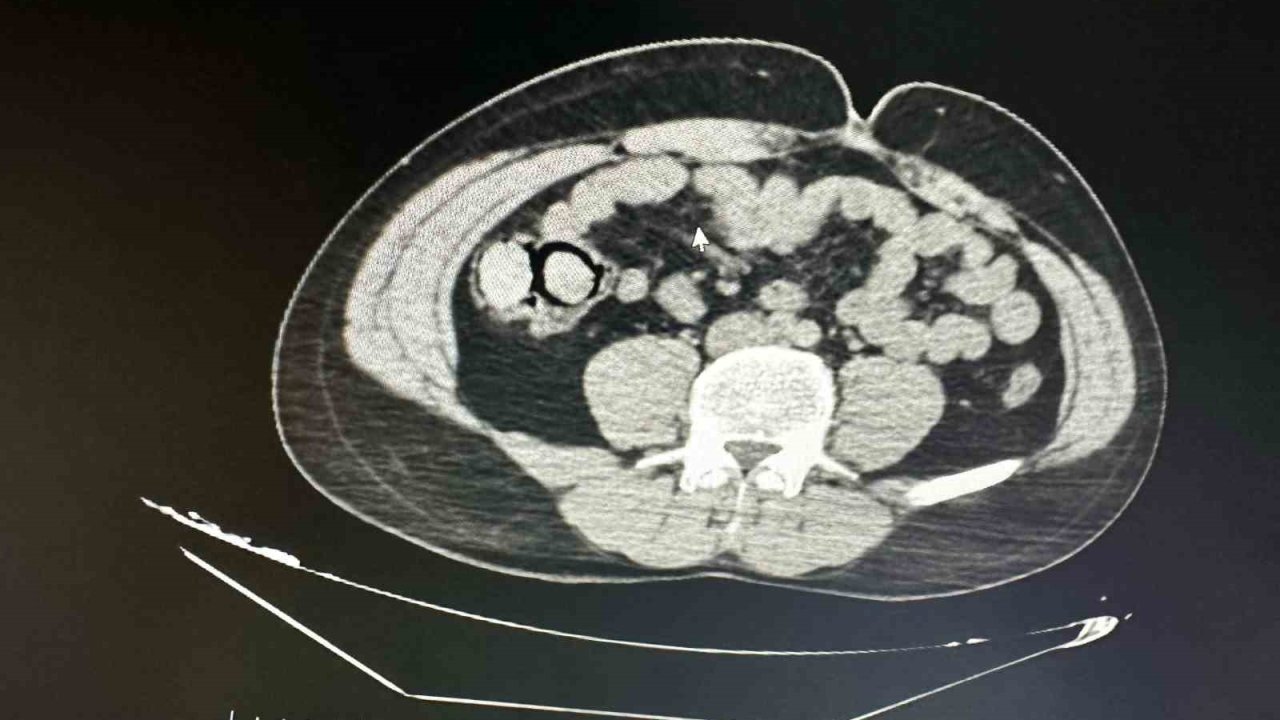 Bu kadarına da pes: Midelerinden 10 parça halinde uyuşturucu çıktı