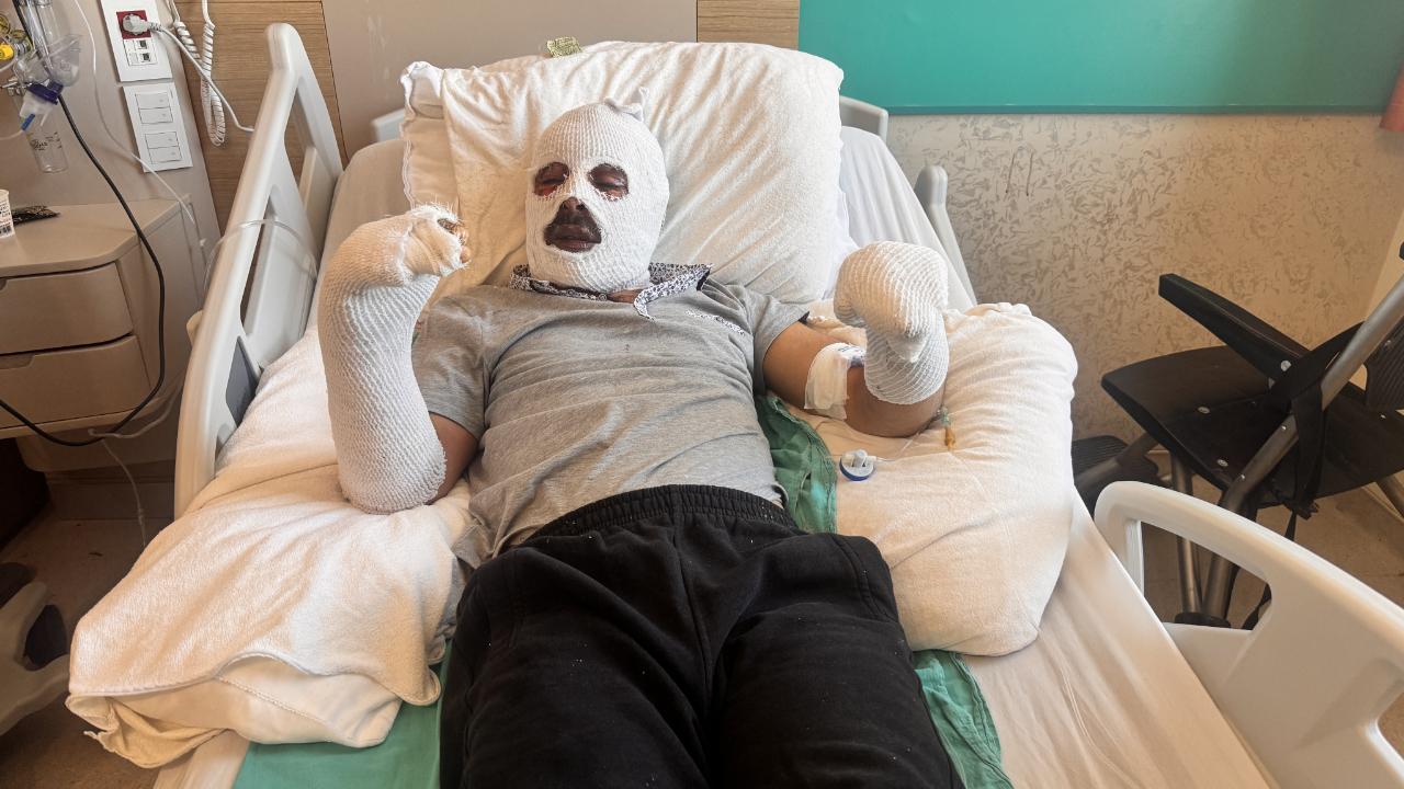 Digor'da tüp patlamasıyla yaralanan genç tedavi görüyor