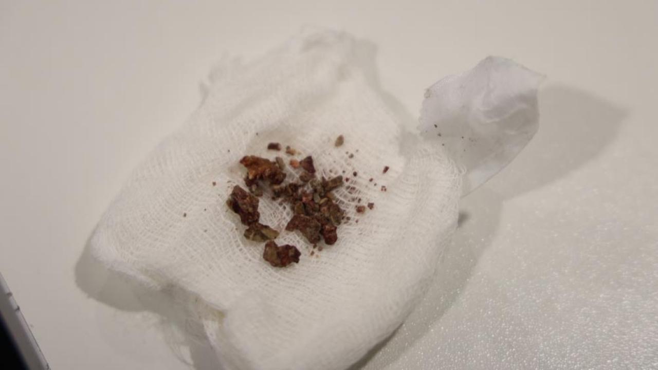 Estetik hayaliyle girdiği ameliyatta burnunda taş bulundu